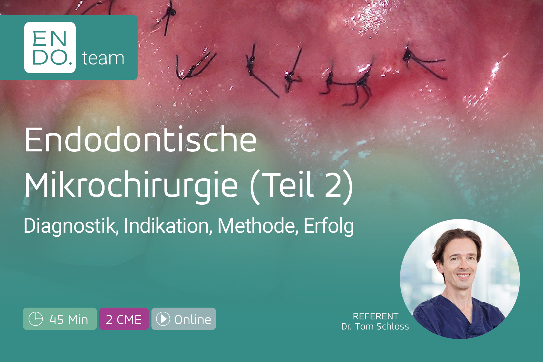 Endodontische Mikrochirurgie - Teil 2