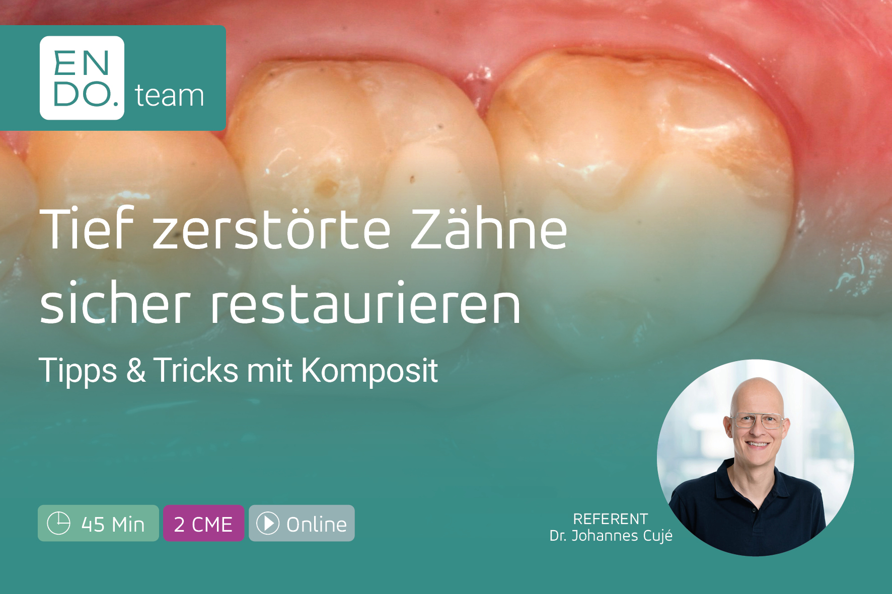 Tief zerstörte Zähne sicher restaurieren