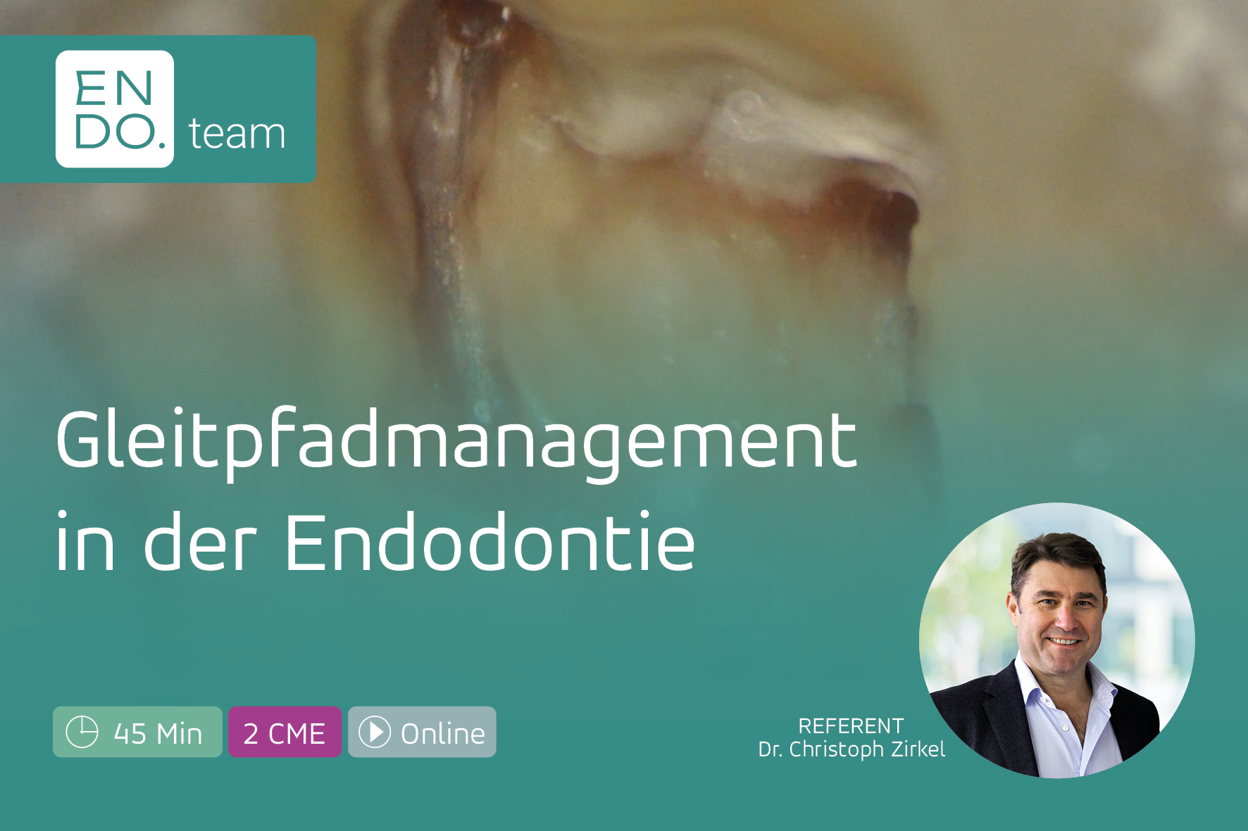 Gleitpfadmanagement in der Endodontie – die Basis für eine sichere Wurzelkanalaufbereitung
